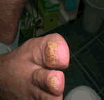 Hongos en los pies hongos en la ua del pie onicomicosis tratamiento avulison quimica