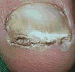 hongos en los pies Onicomicosis