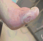 Podologia Pie Diabetico